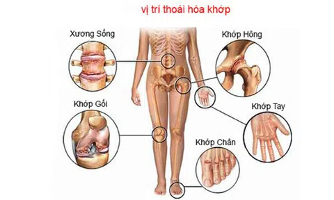 Để viêm khớp dạng thấp không còn là nỗi lo